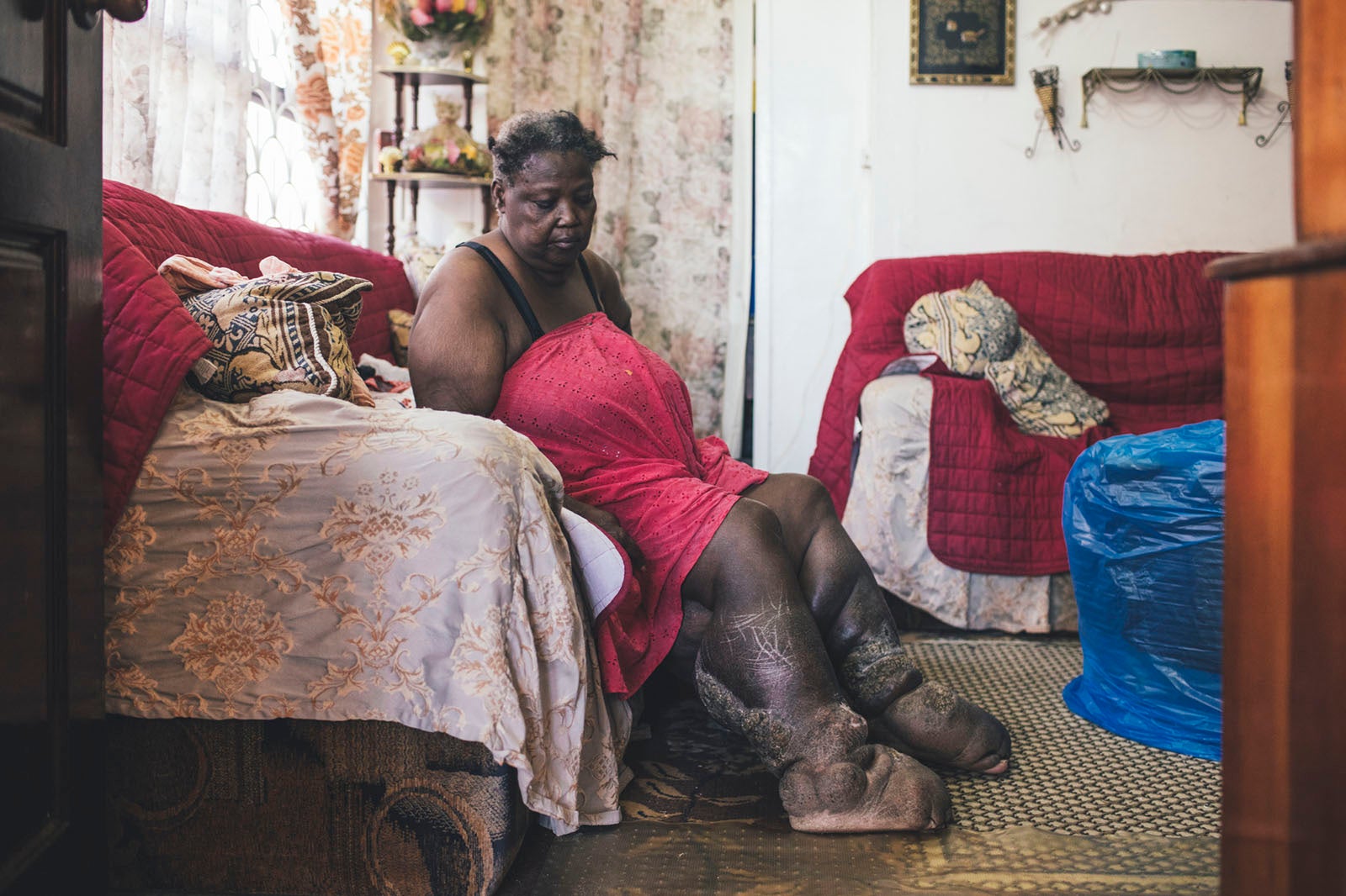 Lymphatic Filariasis 