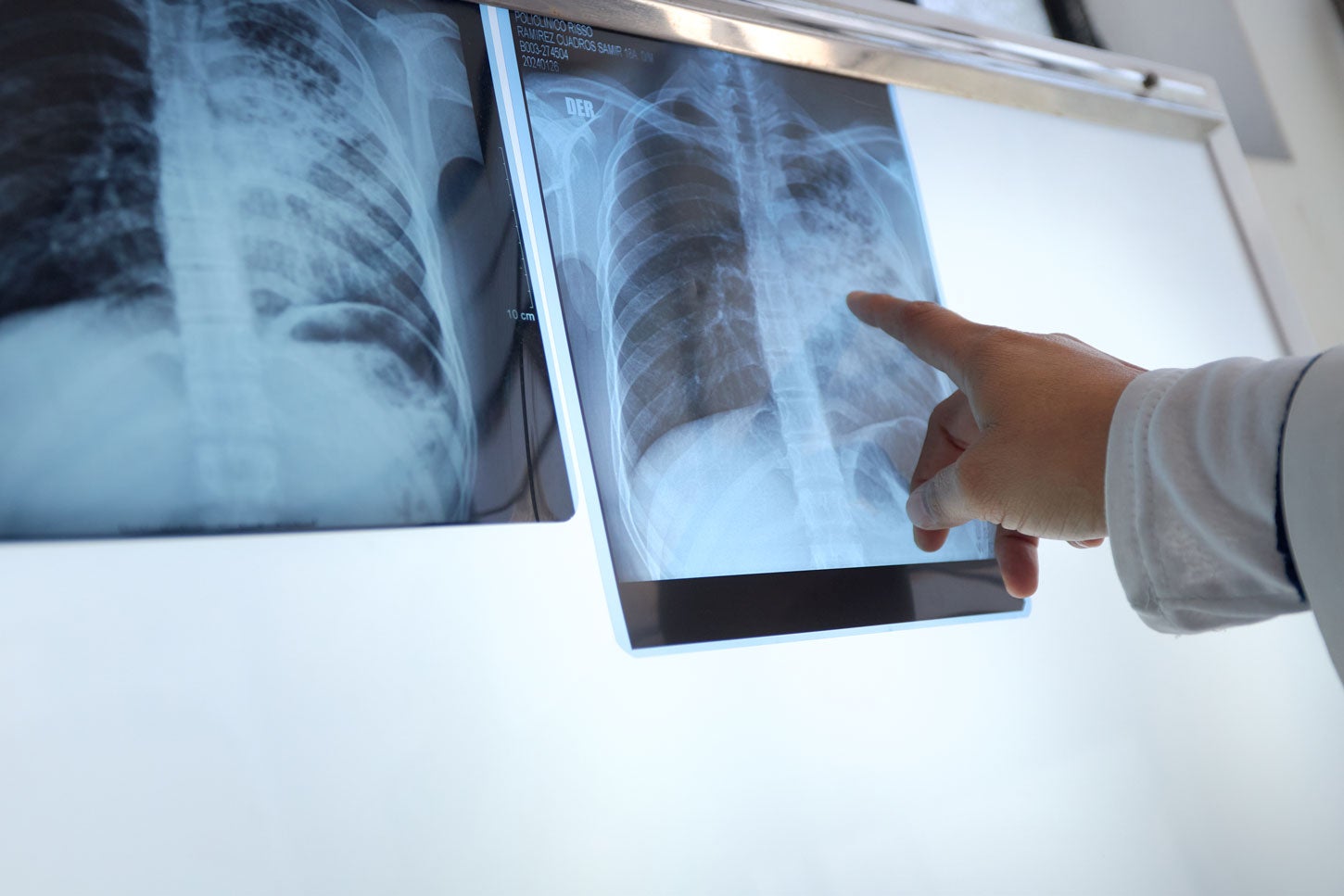 X-rays used to diagnose tuberculosis