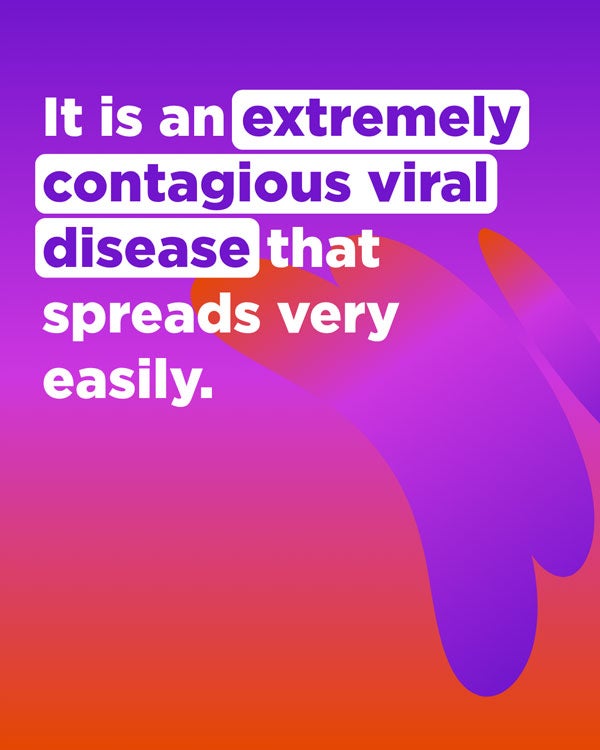 Measles is a extremely contagious viral desease