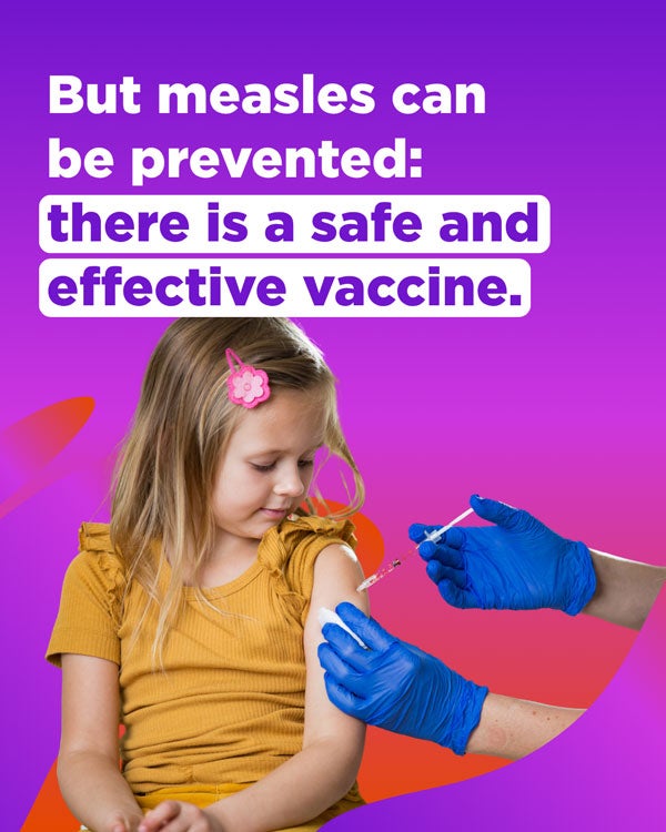 Measles can be prevented with vaccination