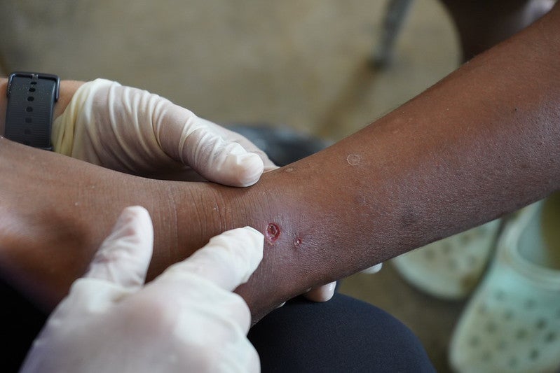 Un hombre con una lesión cutánea está siendo examinado por el personal médico.