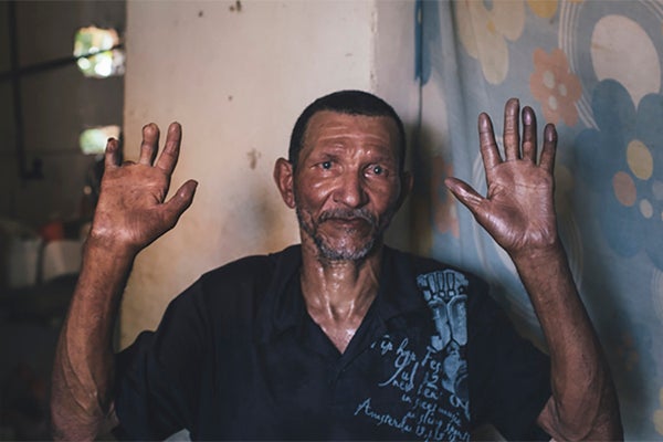 leprosy victim