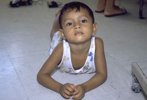 Chronic malnutrition more than twice as high among Hispanic vs. non-Hispanic children in the United States