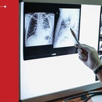 Mycosis in Advanced HIV 