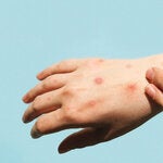 hands with skin lesions