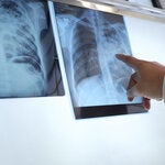 Serie de webinars TB/VIH: Innovaciones diagnósticas para la detección temprana de tuberculosis en personas con VIH