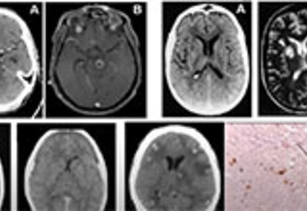 ECHO Educación Continua en Enfermedad Avanzada por VIH - 8 August 2025