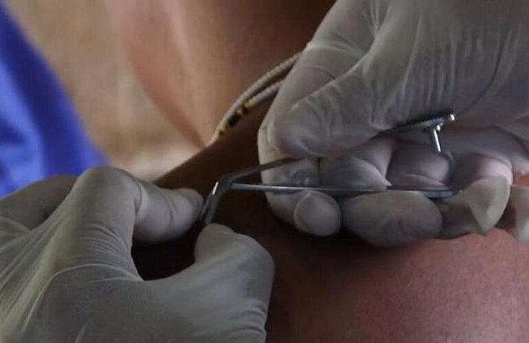 Health worker removes worm from man's back