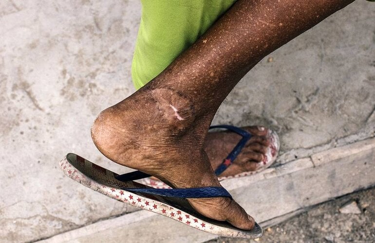 Man affected by cutaneous leishmaniasis