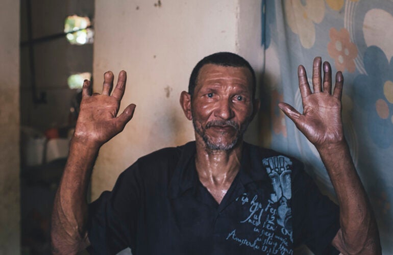 foto de archivo- lepra