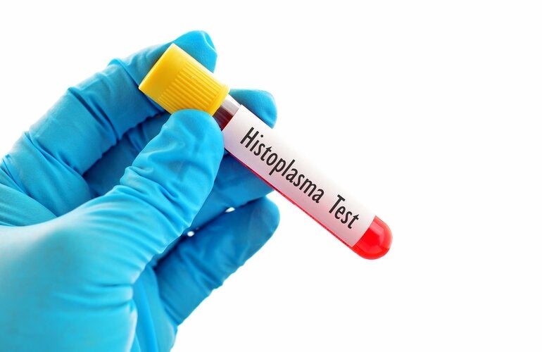 Buscan mejorar diagnóstico y manejo de la histoplasmosis, que afecta a más de 15.000 personas con VIH cada año en las Américas