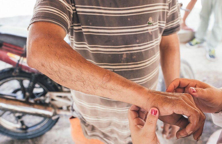 Leishmaniasis control