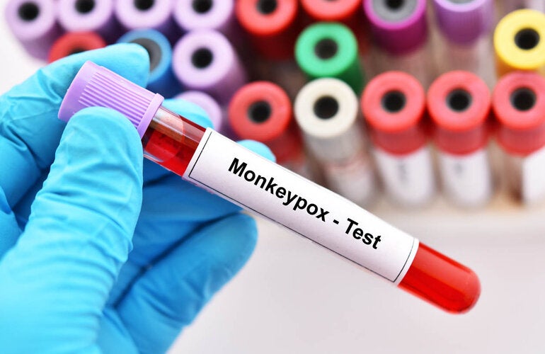 Testing for monkeypox at lab