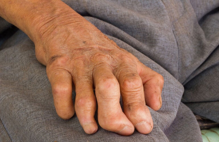 Left hand of a older man impacted by leprosy
