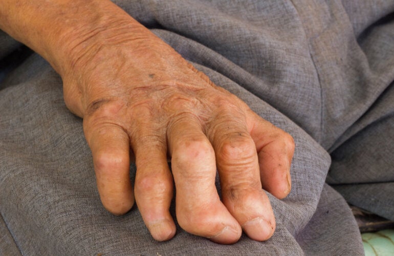 Hand of a person with leprosy