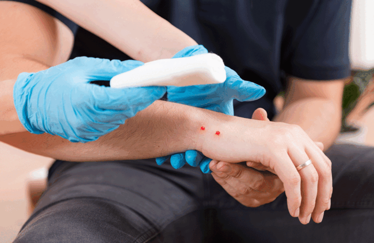 mano con mordedura de serpiente