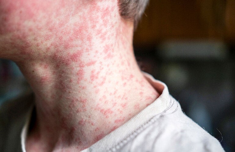 measles patient