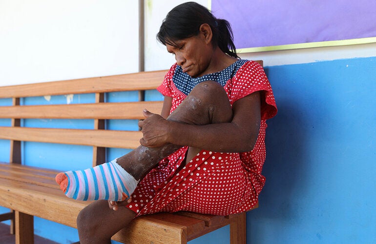 Tungiasis and the guardians of the Amazon