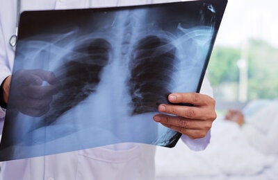 Doctors reading X-Ray with patient in background