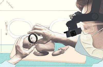 ilustración-Retinopatía-de-la-prematuridad