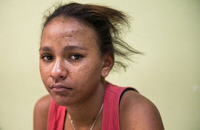 Skin lesions or rash: After her fever and joint pain diminished, this teenager came to the clinic to have her skin checked. In about 50% of cases, chikungunya causes a rash on the face, neck, back, abdomen, arms, legs, palms of the hand or feet.