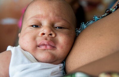 Llanto de dolor: Este bebé, picado por un mosquito Aedes aegypti infectado, llora por el dolor y las lesiones en la piel. Los menores de un año son otro de los grupos de riesgo.