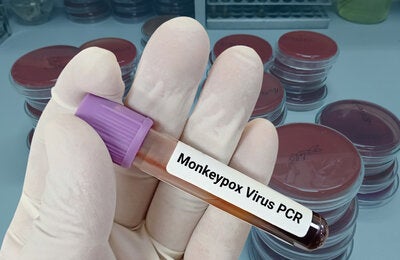 Viruela Símica, Actualización epidemiológica y manejo clínico