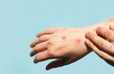 Hands with mpox skin lesions