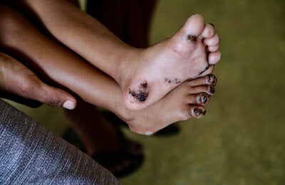 Feet with tunguasis.Tungiasis is a neglected tropical disease caused by the female sand flea Tunga penetrans, which burrows into the skin—most often in the feet—causing severe inflammation, pain, and itching.