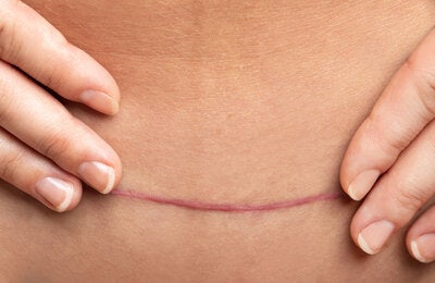 Foto de cicatriz de cesárea