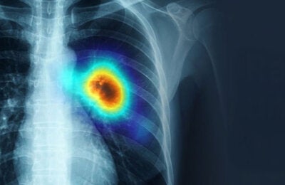 Primer foro para acelerar la eliminación de la TB en la región Andina