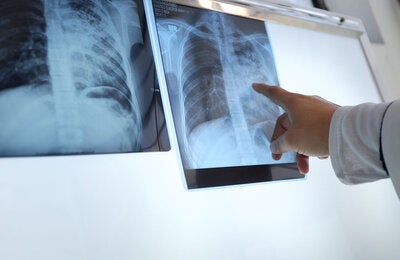 Série de webinars TB/HIV: Inovações diagnósticas para a detecção precoce da tuberculose em pessoas vivendo com HIV