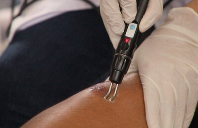 Leishmaniose