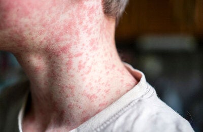 measles patient