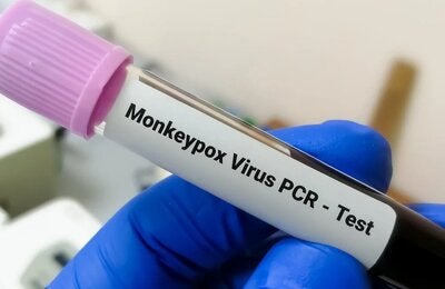 Tubo de ensayo con la prueba PCR del virus de la viruela del mono 