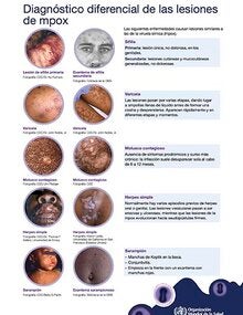 Diagnóstico diferencial de las lesionesde mpox