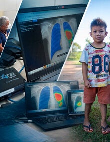 Día mundial de la tuberculosis 2026