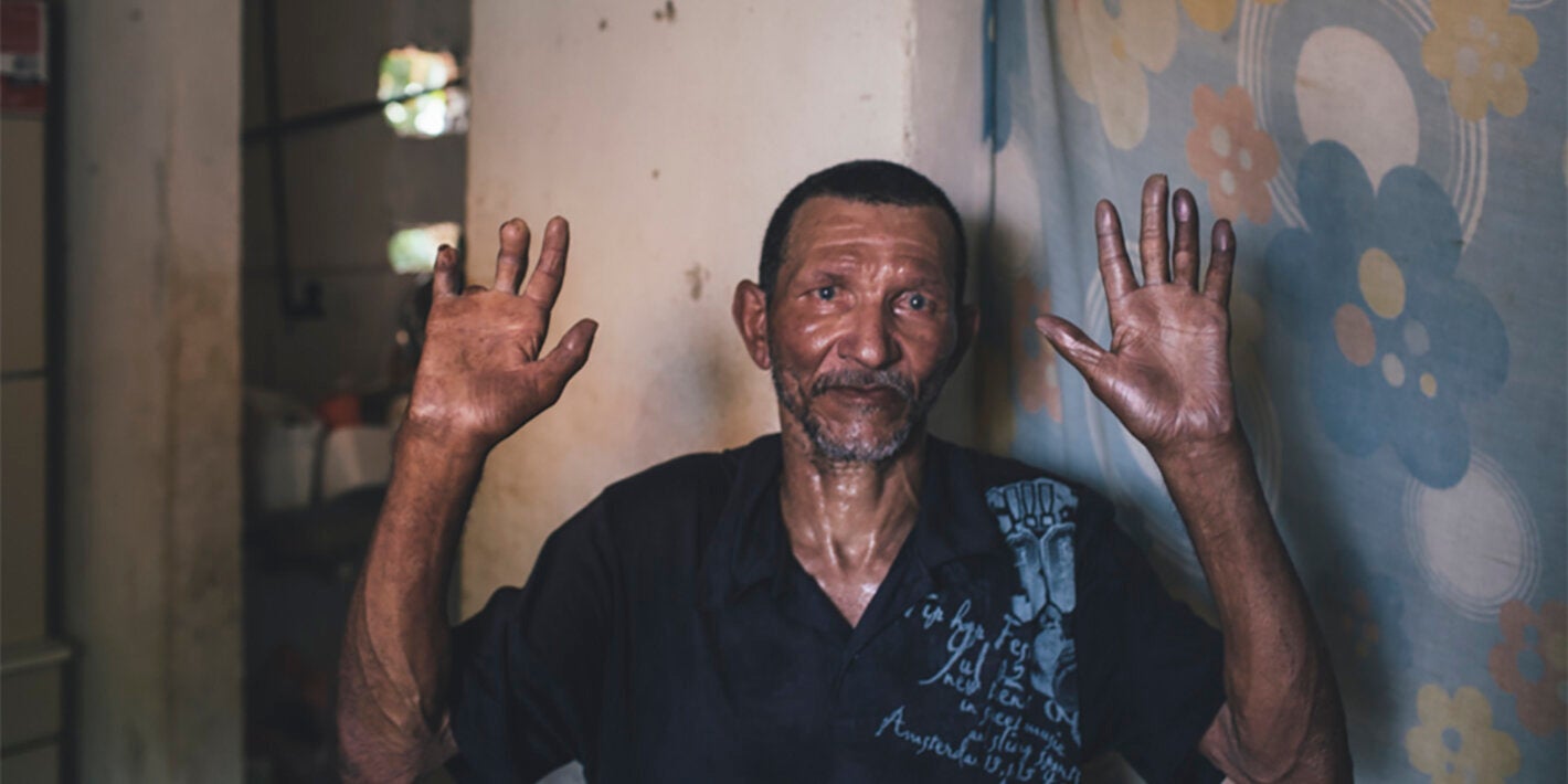 foto de archivo- lepra