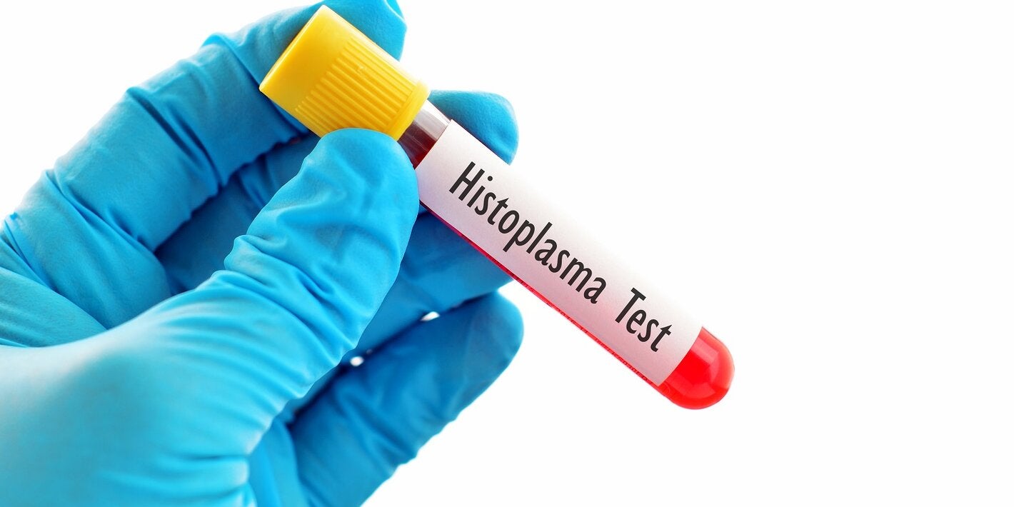 Buscan mejorar diagnóstico y manejo de la histoplasmosis, que afecta a más de 15.000 personas con VIH cada año en las Américas