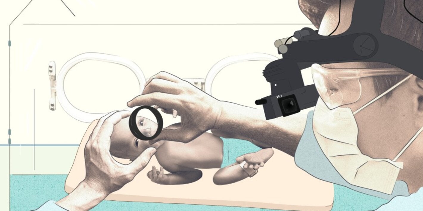 ilustración-Retinopatía-de-la-prematuridad