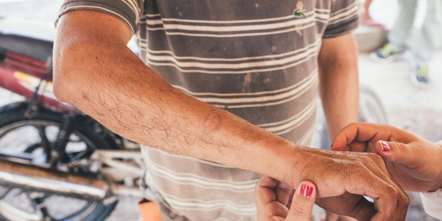 Leishmaniasis control