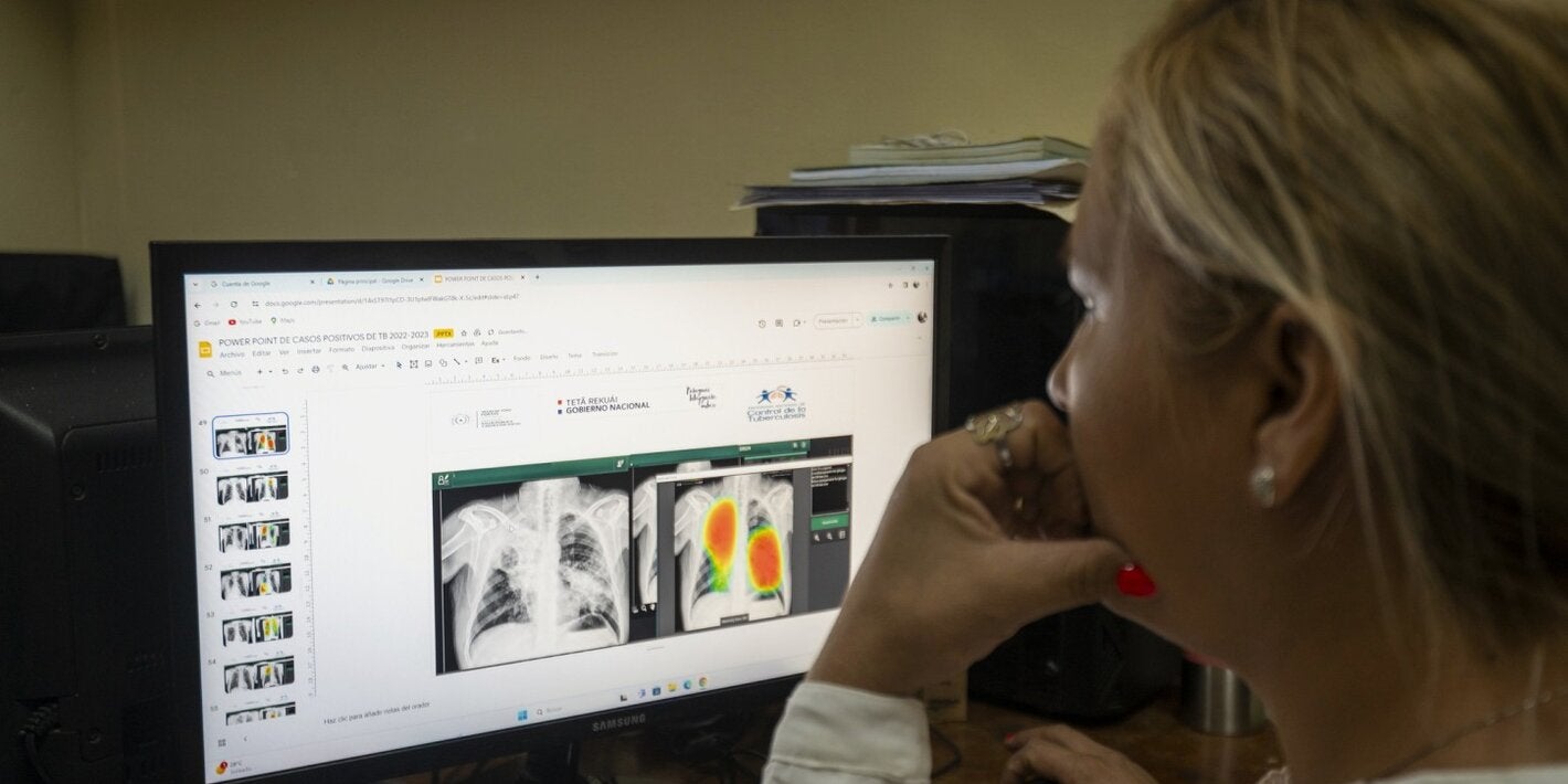 Imaging being used to diagnose tuberculosis