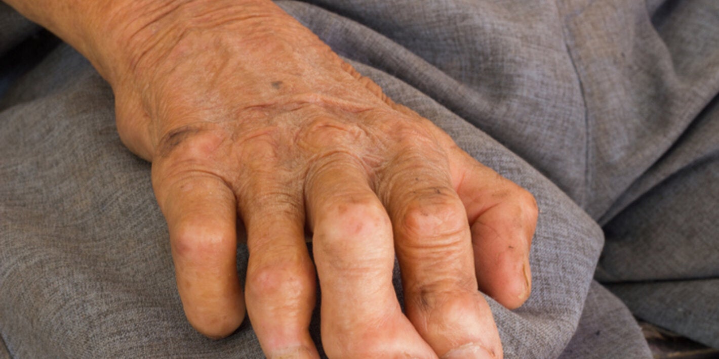 Hand of a person with leprosy