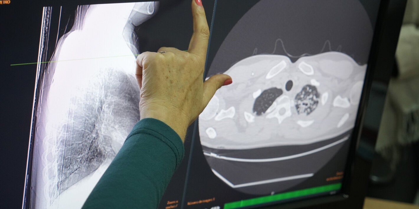 placa radiográfica de torax para la detección de TB drogo-resistente