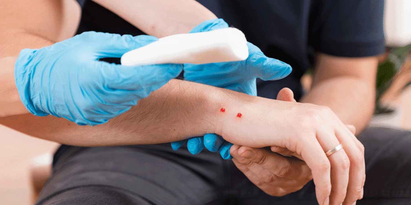 mano con mordedura de serpiente