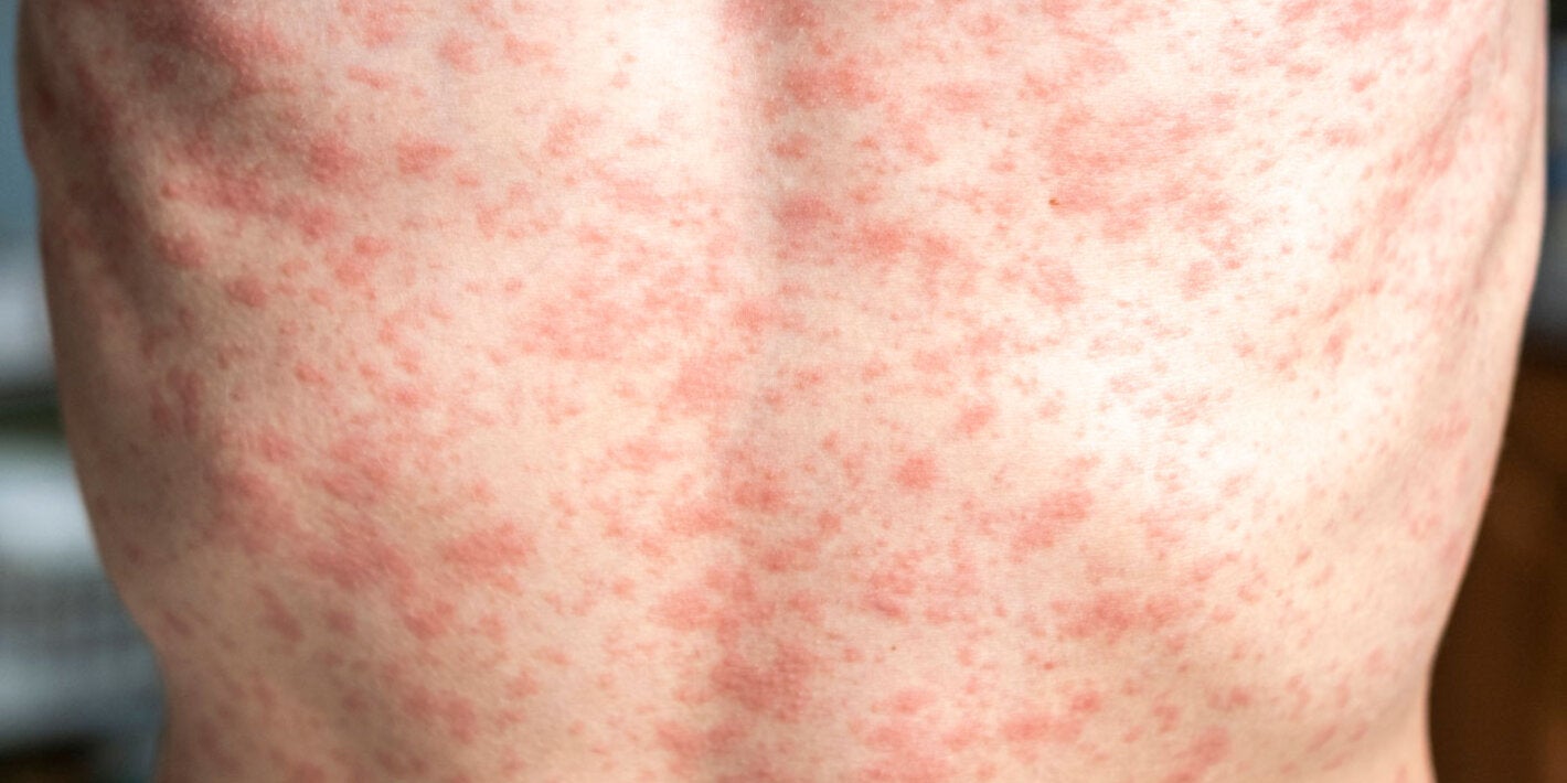 Patient with measles