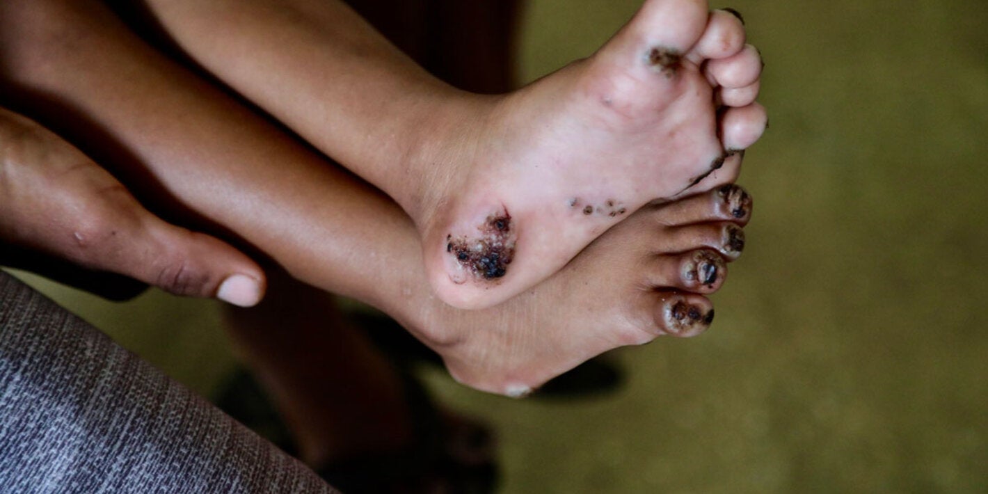 Feet with tunguasis.Tungiasis is a neglected tropical disease caused by the female sand flea Tunga penetrans, which burrows into the skin—most often in the feet—causing severe inflammation, pain, and itching.