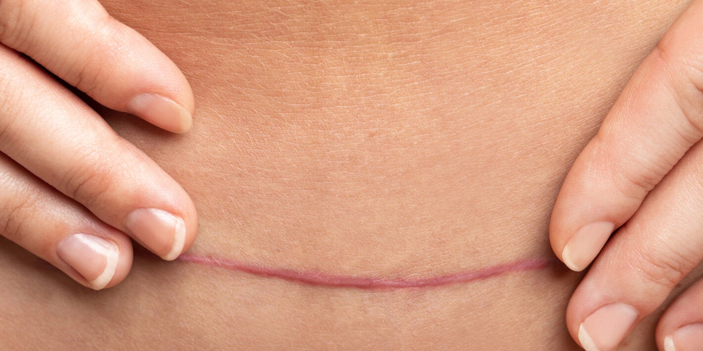 Foto de cicatriz de cesárea