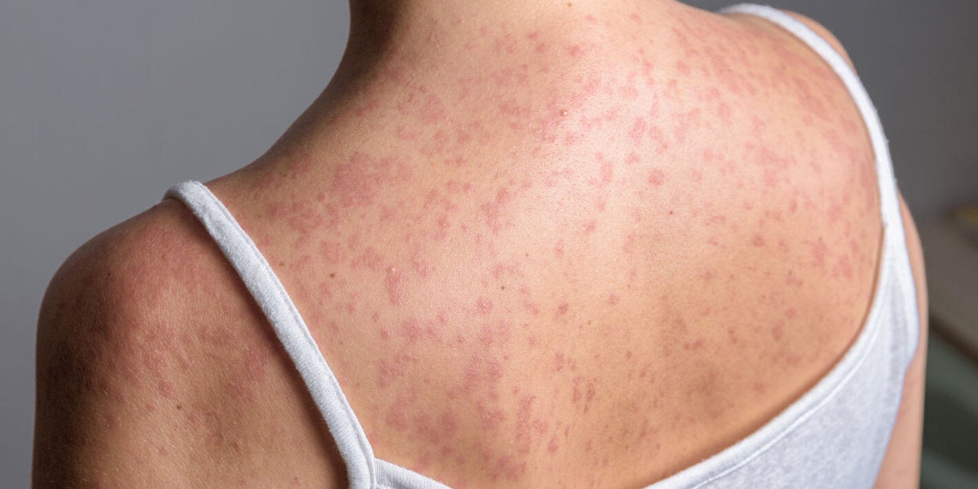 Paciente con  sarampión