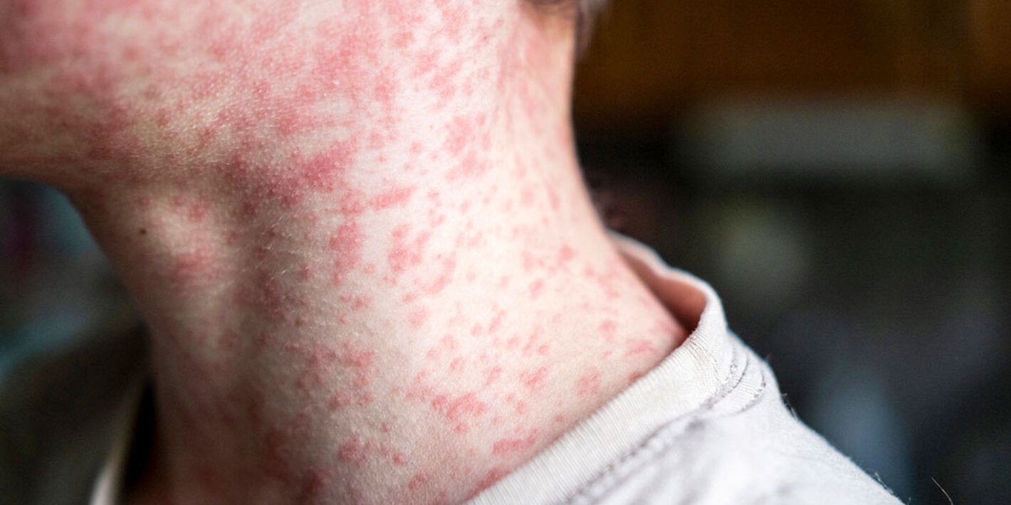 measles patient